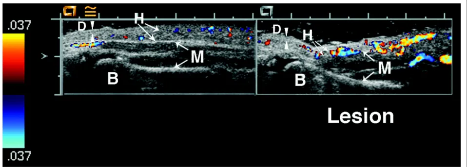 Figure 6 6 year old girl with linear scleroderma of her calf for the past two yearson the lesion side compared to the normal muscle (deep tissue vascularity = 3)