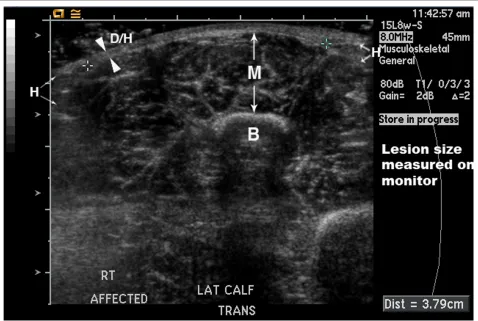Figure 8 8 year old girl with linear scleroderma of her lower leg with a four year history of active disease