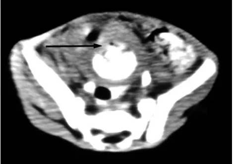 Fig 1. Computed tomography of the pelvis. The anterior superiorbladder wall is thickened and irregular