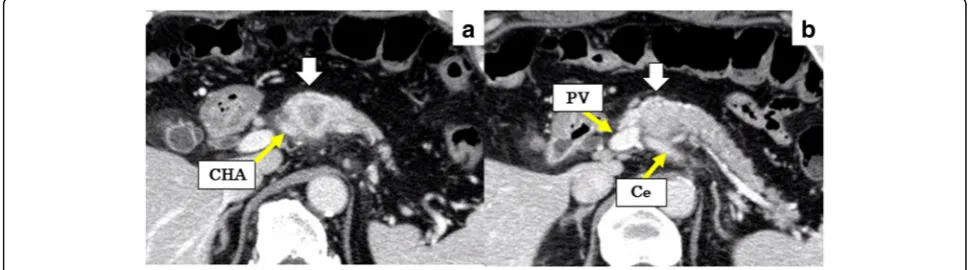 Fig. 1 Abdominal CT scan at the initial diagnosis at the previous hospital. The white arrows indicate the pancreatic tumor
