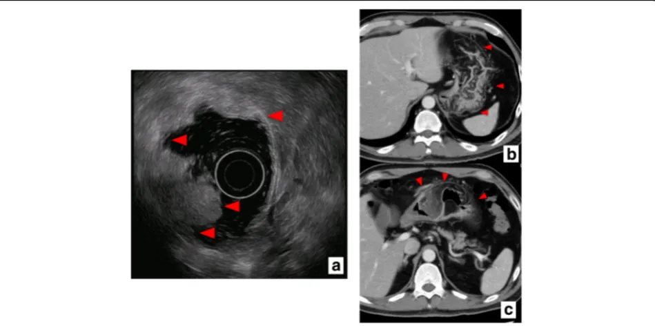 Fig. 1 ahyperplastic polyps are seen on the mucosa (, b Findings on upper GI endoscopy