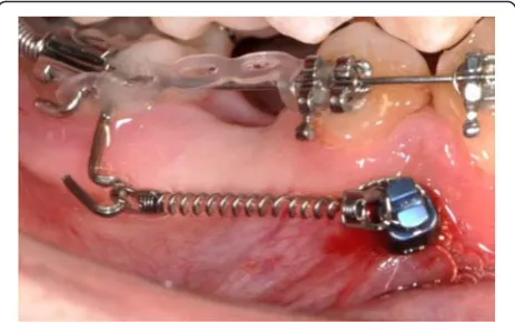 Fig. 2 An orthodontic mini-implant* immediately after insertion andorthodontic loading
