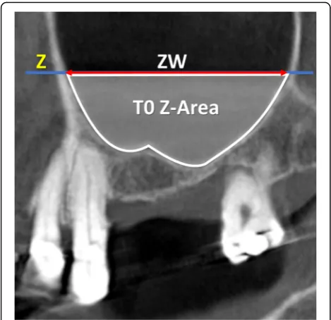 Fig. 2 T0, lateral view of a no-membrane CBCT; Z, line drawnfollowing the floor of the nose; ZW (sinus extension), distanceevaluated on the line Z between the two intersection points withthe mesial and distal sinus bone walls; T0 Z-Area, area delimited bythe sinus bone walls and the line Z