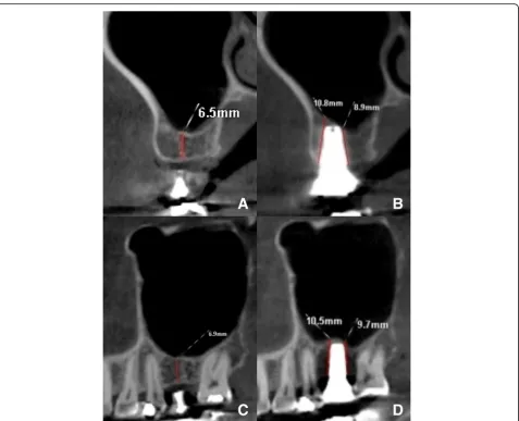 Fig. 1 Case 1: The CBCT images of implant site 16 before (left column) and 6 months after surgery (right column)