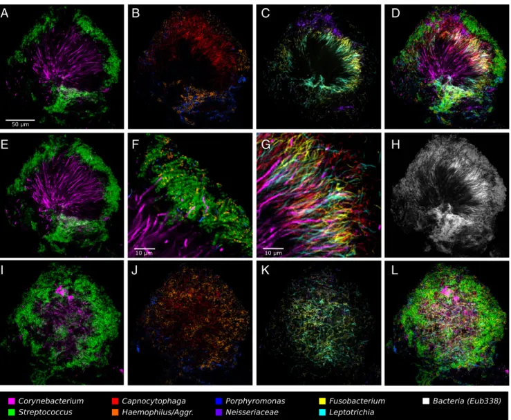 Fig. 3. A hedgehog structure in plaque showing spatial organization of the plaque microbiome