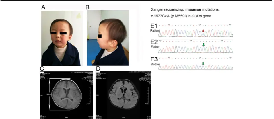 Fig. 2 Dysmorphic features, brain MRI and exome sequencing of patient 2. a Anterior photograph of the proband at 24-months of age
