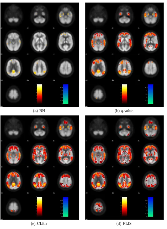 Figure 4. Z-values of the signals found by each procedure for the comparison between NC and MCI.
