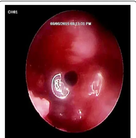 Fig. 4 Schematic drawing showing entrance of the endoscope fromthe crestal osteotomy site after sinus membrane elevation to assessthe integrity of the membrane