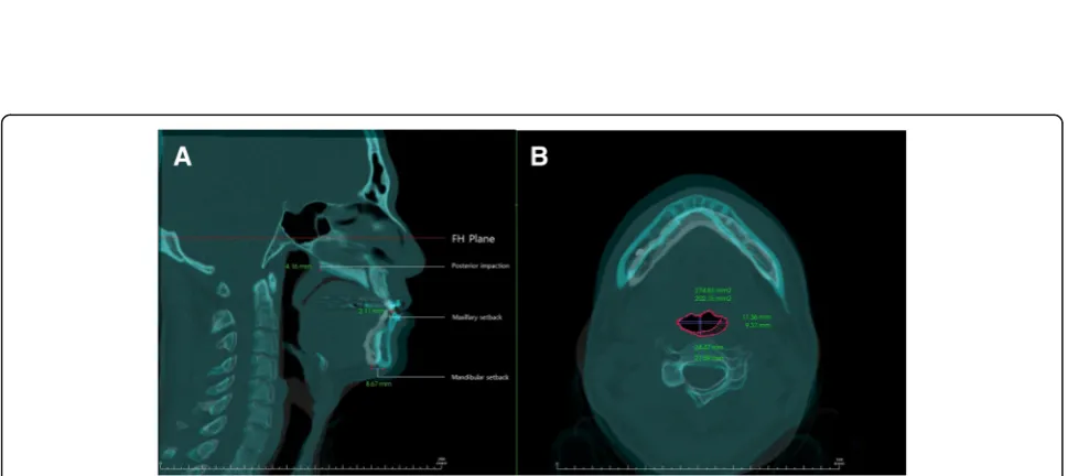 Fig. 2 Landmarks and reference plane of total airway space. C1, C2, and C3: The lower most protruding parts of cervical vertebrae 1, 2, and 3.C1-F, C2-F, and C3-F: Planes parallel to FH plane and through C1, C2, and C3