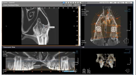 Fig. 1 Determination of the remaining bone height (RBH) on the CBCT image