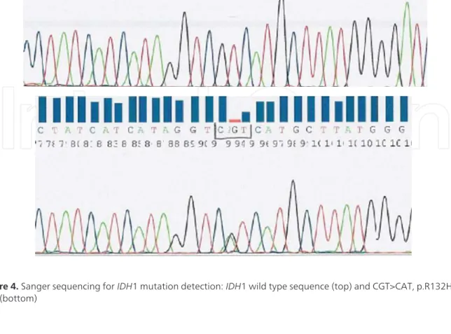 Figure 4. Sanger sequencing for IDH1 mutation detection: IDH1 wild type sequence (top) and CGT>CAT, p.R132H mu‐