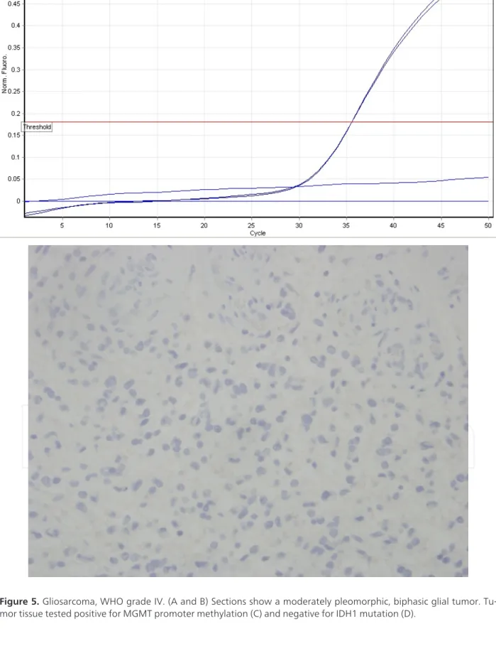 Figure 5. Gliosarcoma, WHO grade IV. (A and B) Sections show a moderately pleomorphic, biphasic glial tumor