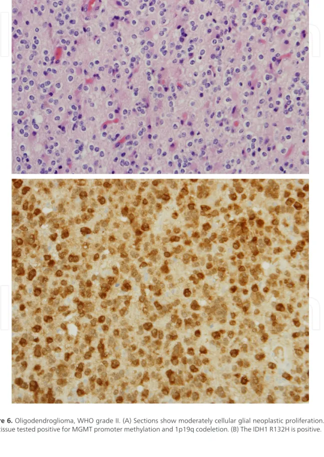 Figure 6. Oligodendroglioma, WHO grade II. (A) Sections show moderately cellular glial neoplastic proliferation