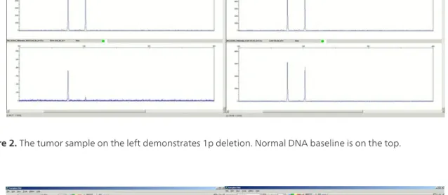 Figure 2. The tumor sample on the left demonstrates 1p deletion. Normal DNA baseline is on the top.