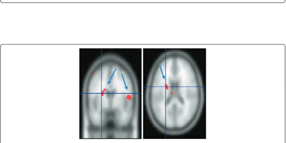Figure 3 Areas of the brain activated by humorous scenes. Bilateral middle temporal gyrus, left superior temporal gyrus, right fusiform gyrus,right parahippocampal gyrus, left uncus, left inferior frontal gyrus, and right middle frontal gyrus were activated while experiencing humor.
