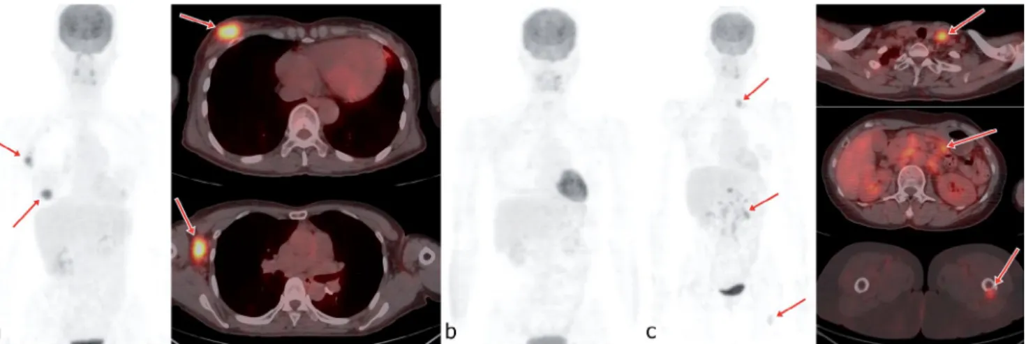 Figure 5. A. A 68-year-old female patient diagnosed with invasive IDC (pSUVmax 1.0, tumor size 1.5 cm, ER+, PR+, HER2+, HIF-1a 1+) and no  recurrence of IDC during 5-year follow-up period; B