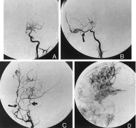 Fig 1. Selective cerebral angiograms in patient 5 before and after cerebral revascularization