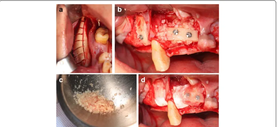 Fig. 1 Procedure of MBB graft. a Donor site after sawing mandibular body bone. b Fixed block bone by lag screw technique
