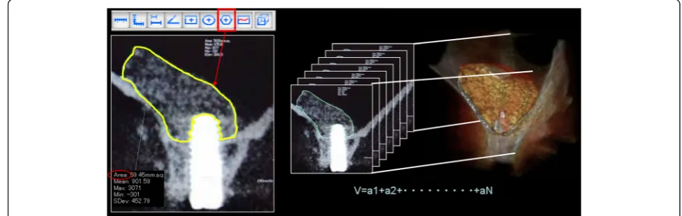 Fig. 1 Treatment protocol for the present study. Postoperative CBCT was performed a minimum of three times, i.e., immediately, 6 months, and2.5 years after implant placement
