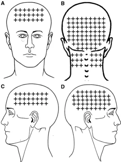 Fig. 1 Areas showing the spontaneous pain symptoms of childrenregion;with chronic tension type headache: a Frontal region; b Occipital c Non-dominant side; d Dominant side