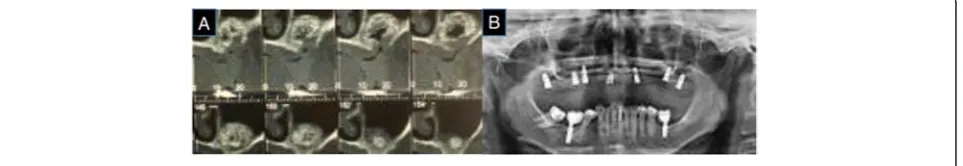 Fig. 3 a CT with a circular image suggesting potential cystformation. b Open-access window without any secretion at the site.c The site was irrigated using saline with added antibiotics