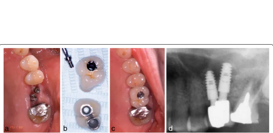 Fig. 4 Case 1. November 2006. Six months after implant insertion. a–c The superstructure was attached with a screw