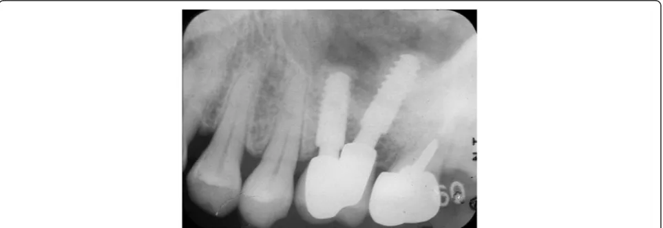 Fig. 9 Case 1. April 2013. Six years and 5 months after superstructure placement.brush can easily clean the interimplant space