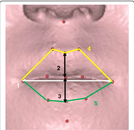 Fig. 2 Linear variables. 1, cheilion width; 2, upper lip height; 3, lower lipheight; 4, upper lip vermilion length; and 5, lower lip vermilion length
