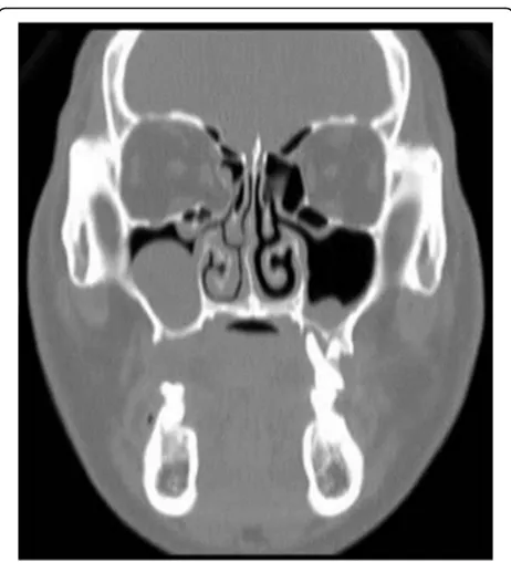 Fig. 5 Panoramic radiograph 3 years and 9 months after sinus bonegraft. There were no postoperative complications