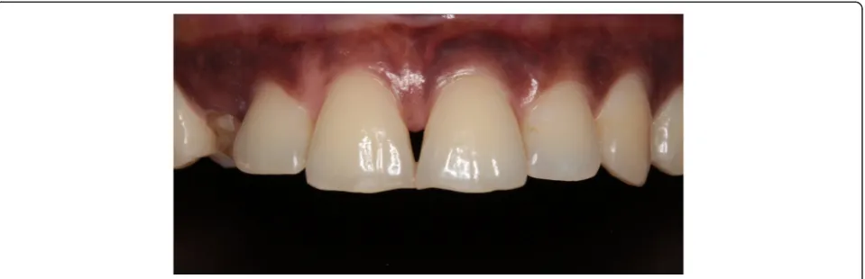 Fig. 2 CBCT image showing the buccal location of the impactedsecondary canine
