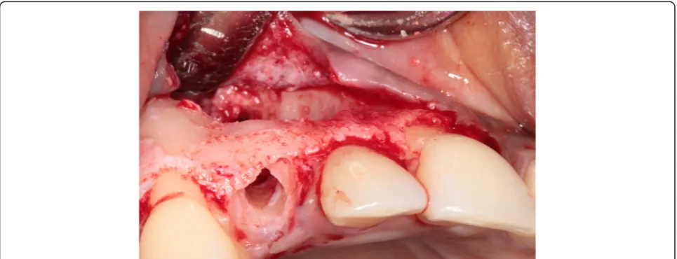 Fig. 3 The impacted canine has become visible after elevation of a full-thickness buccal mucoperiosteal flap and removing overlying bone