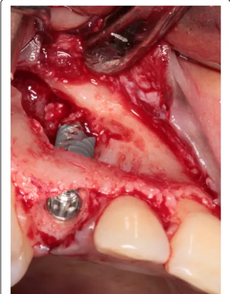 Fig 6 Situation after implant placement and restoration of the bonydefect with a 1:1 mixture of Bio-Oss® and autologous bone