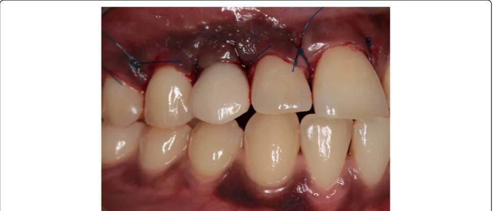 Fig. 8 Clinical view showing optimal esthetics around the screw-retained definitive all-ceramic crown