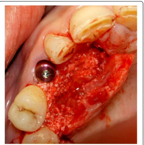 Fig. 12 The impacted canine has become visible after elevation of afull-thickness palatal flap and removing overlying bon