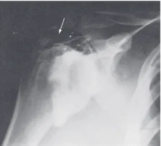 Figure 46-6  Multidetector computed tomography revealing a superior  labral tear of the shoulder