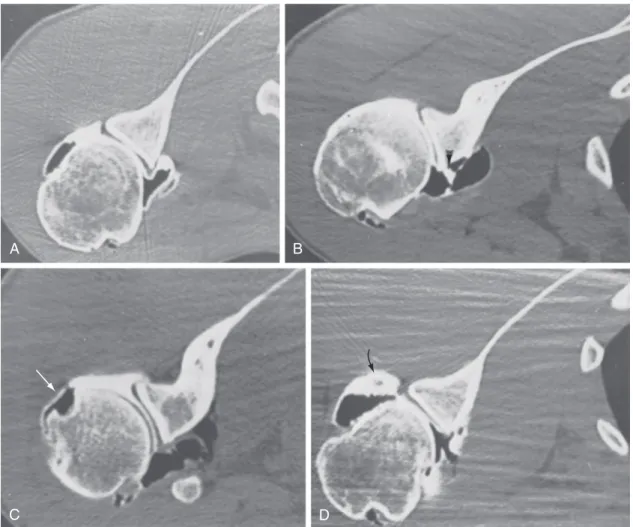 Figure 46-9  CT-arthrography of the shoulder. A, Normal findings. B, Tear of the anterior glenoid labrum