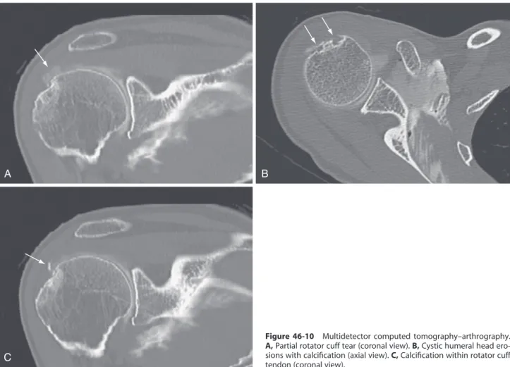 Figure  46-10  Multidetector  computed  tomography–arthrography. 