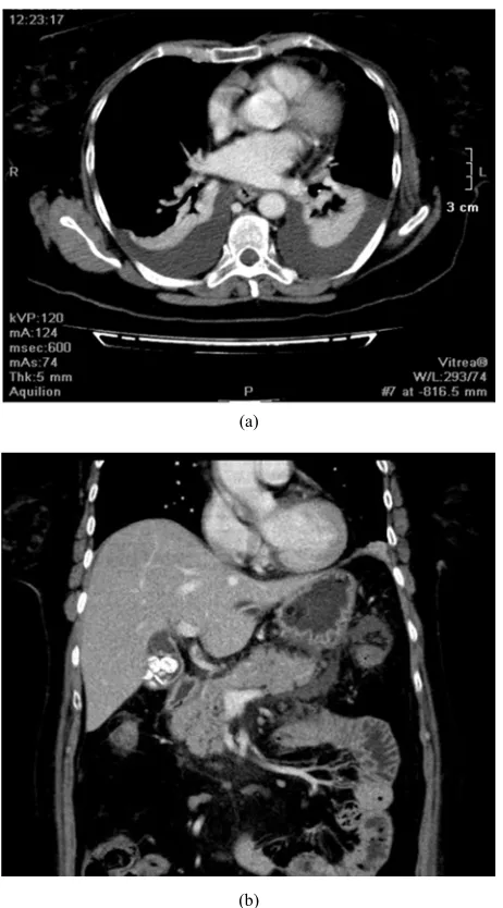 Figure 5. Axial image of 66 yrs old male showing cystic lesion in the tail of pancreas representing pseudocyst formation there is also aneurysmal dilatation of the splenic artery projecting into the pancreatic pseudocyst
