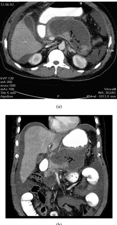 Figure 7. (a) Axial and (b) coronal reconstructed images of 50 yrs old male peripheral rim of contrast enhancement and multiple pockets of air lucencies with presence of a large abscess in the body and tail of pancreas, it shows within it