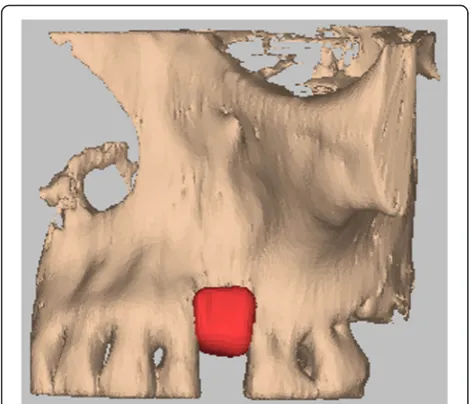 Fig. 4 Hydroxyapatite bone graft CAD/CAM inserted at the level ofthe bone defect
