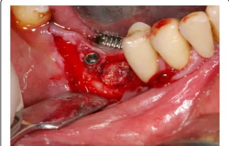 Fig. 16 Clinical view: regenerated bone after 5 months