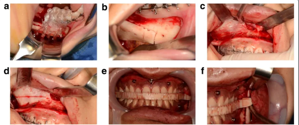 Fig. 5 Modeling phase. a. Cutting guide (mandible). b. Cutting guide (maxilla). c. Computer-generated surgical stent (right side)