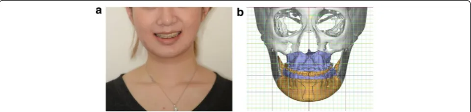 Fig. 8 Preoperative application of the Balanced Orthognathic Surgery (BOS) protocol. a