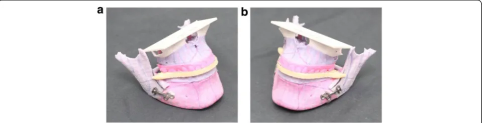 Fig. 10 Computer-generated intermediate wafer and pre-bent plates act as splints to precisely reposition the proximal segments