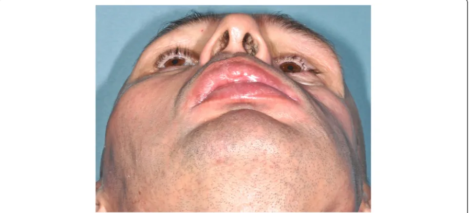 Figure 1 Initial trauma event during which the bone segments were lost.
