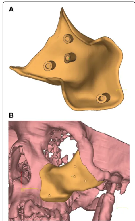 Figure 3 CT scan confirming the left zygomatic deficiency: (A)Axial, (B) Coronal.