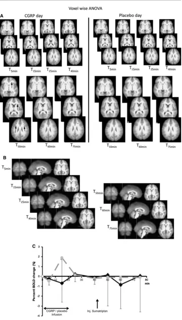 Fig. 2 a One-way voxel-wiseANOVA results from themeasured time points at theCGRP day (left side) andplacebo day (right side).ANOVA showed no statisticalchanges over time in activatedvoxels after CGRP and placeboinfusion except some scatteredactivation afte