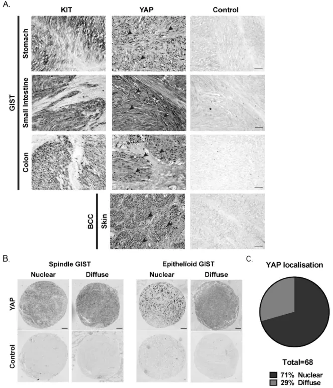 Figure 3: YAP expression in human GIST primary tumors.  A) Immunohistochemistry for KIT-ir and YAP-ir in three different  human GIST primary tumors of stomach, small intestine and colon, respectively