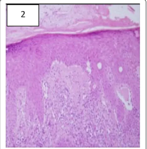Figure 2 Histopathology of the involved skin from the dorsalaspects of a finger showing typical changes of cutaneousLupus Erythematosus including vacuolar degeneration of thebasal- cell layer, and focal thickening of the basementmembrane (hematoxylin and eosin, x100).