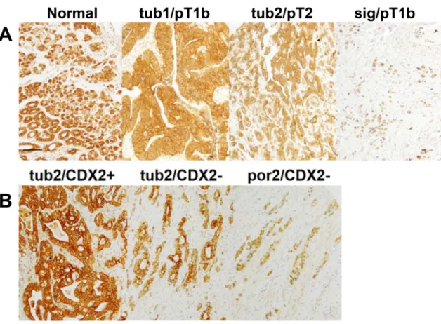 Figure 1: CLDN4 expression in gastric adenocarcinomas.  (A) A conducted immunohistochemical evaluation identified CLDN4  expression at the cytoplasmic membrane of the normal gastric mucosa, and in both the cytoplasmic membrane and cytoplasm of three  repre